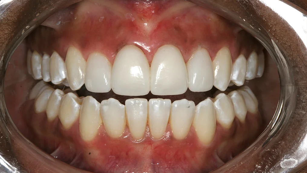 After dental treatment at Metropolitan Dental Centre, case 01