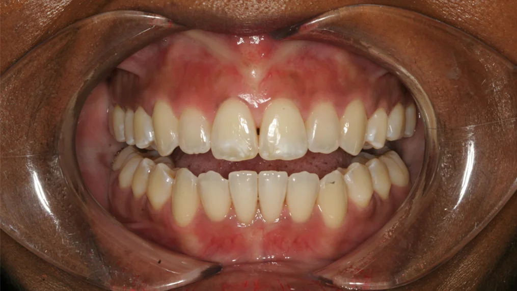 Before dental treatment at Metropolitan Dental Centre, case 01