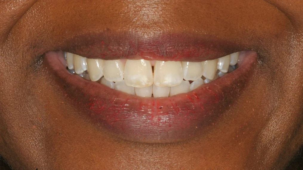 Before — Metropolitan Dental Centre case 01
