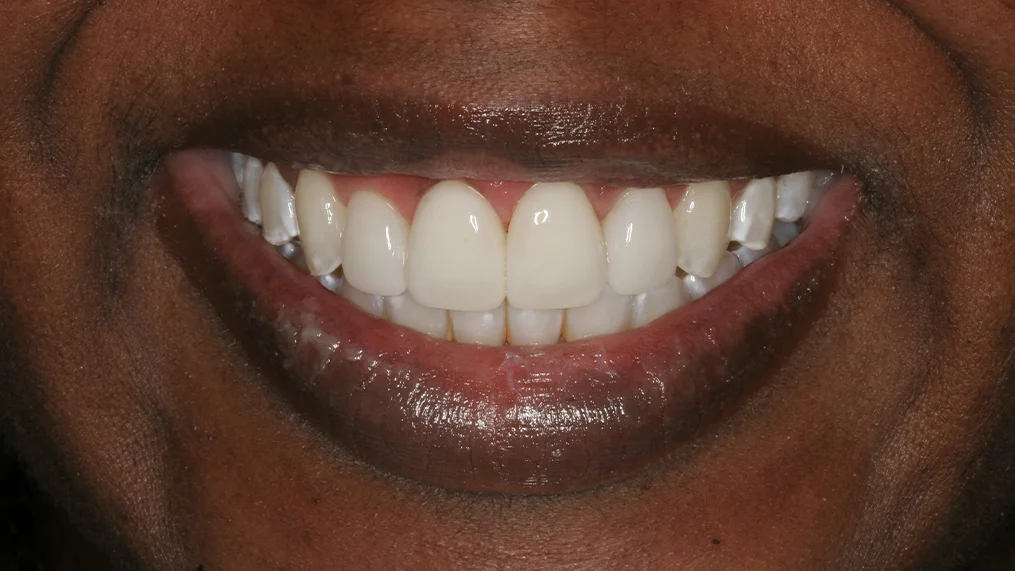 After — Metropolitan Dental Centre case 01