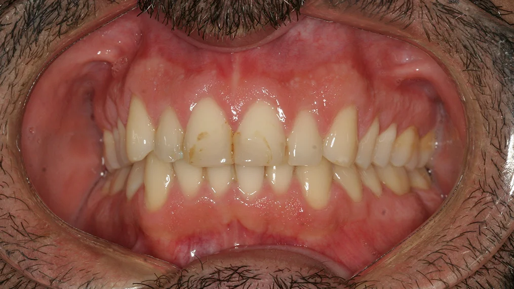 Before dental treatment at Metropolitan Dental Centre, case 02