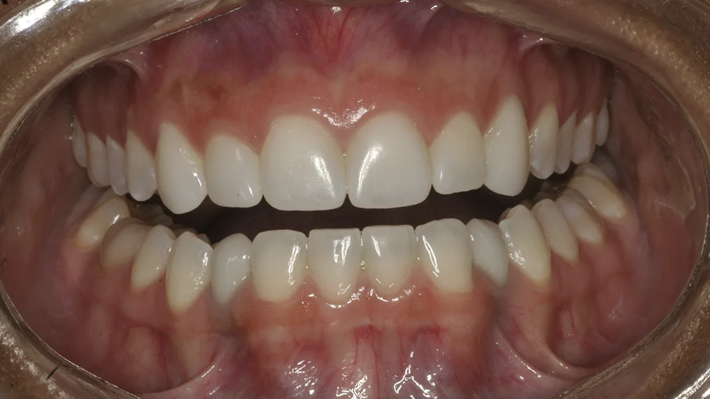 After dental treatment at Metropolitan Dental Centre, case 03