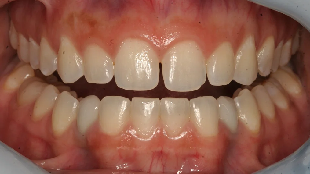 Before dental treatment at Metropolitan Dental Centre, case 03