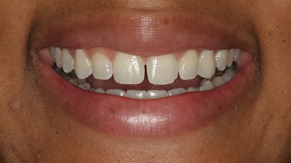 Before — Metropolitan Dental Centre case 03