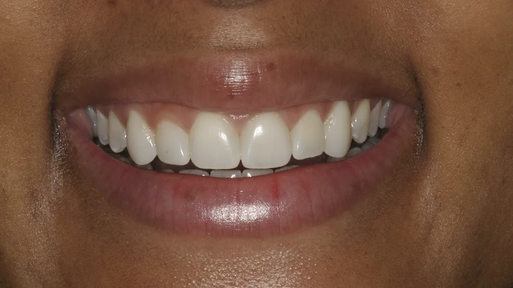 After — Metropolitan Dental Centre case 03