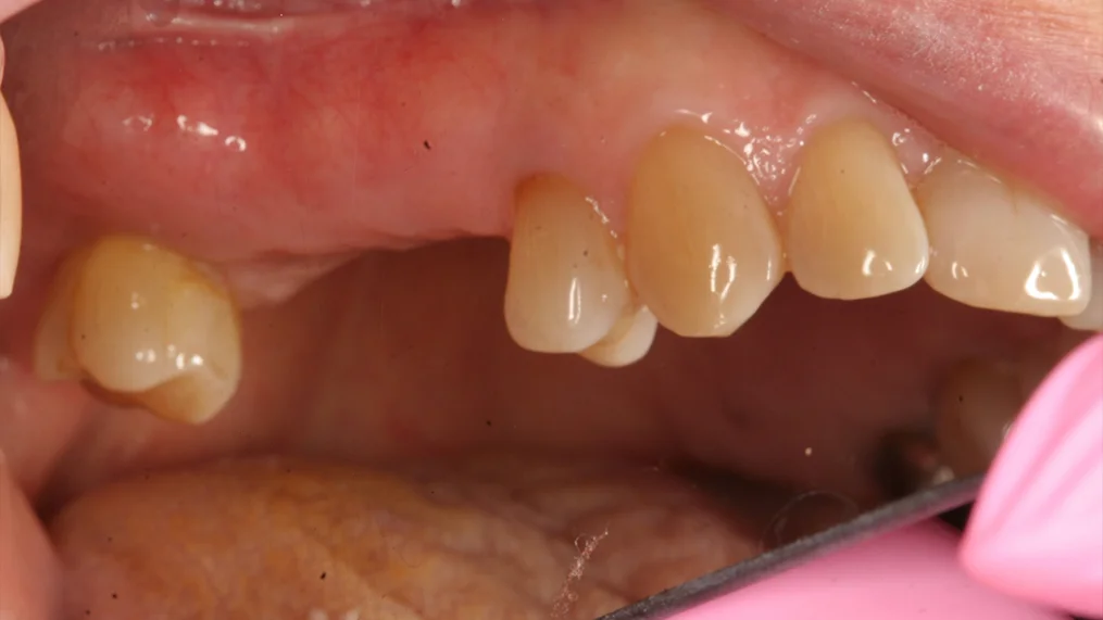 Before dental treatment at Metropolitan Dental Centre, case 04