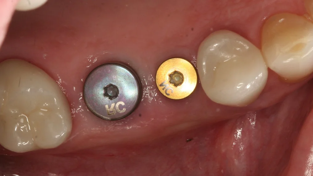 Before — Metropolitan Dental Centre case 04