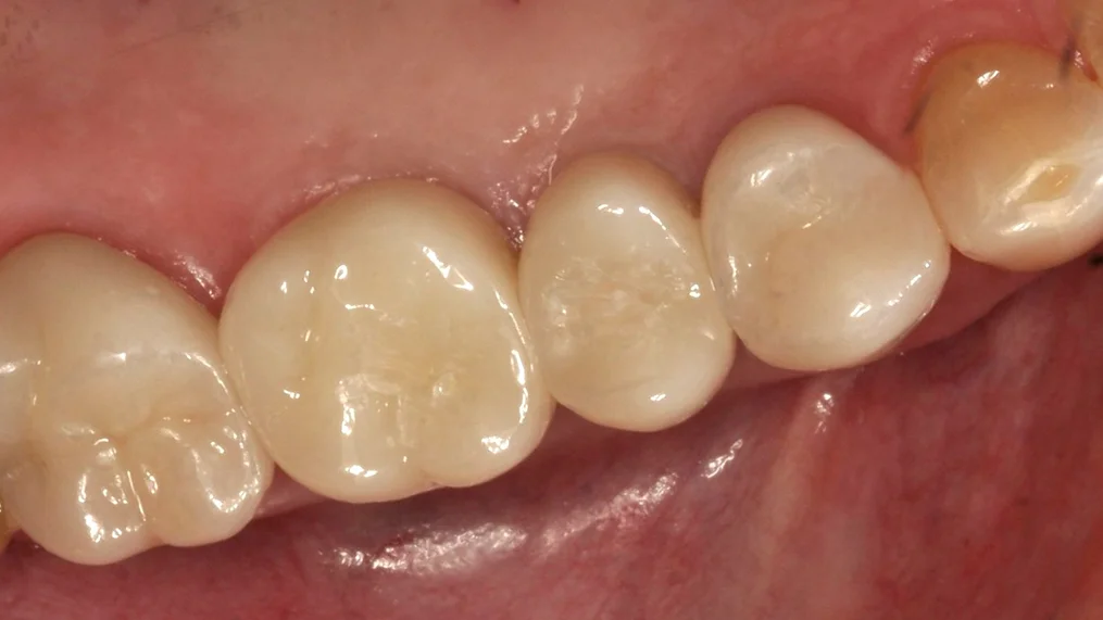 After — Metropolitan Dental Centre case 04