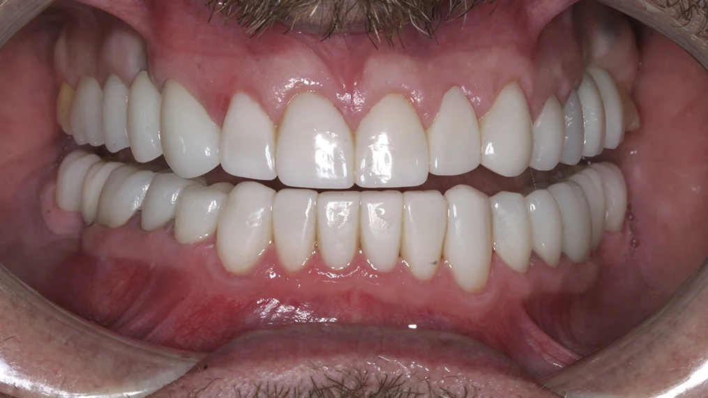 After dental treatment at Metropolitan Dental Centre, case 05