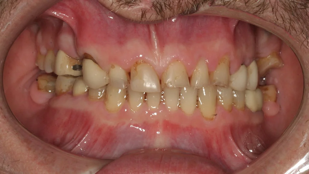 Before dental treatment at Metropolitan Dental Centre, case 05