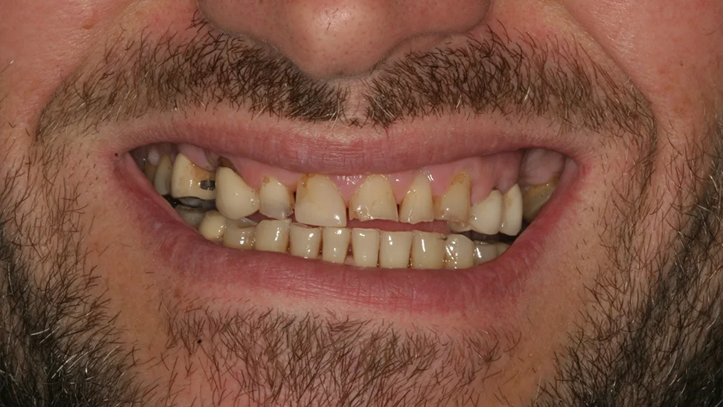Before — Metropolitan Dental Centre case 05