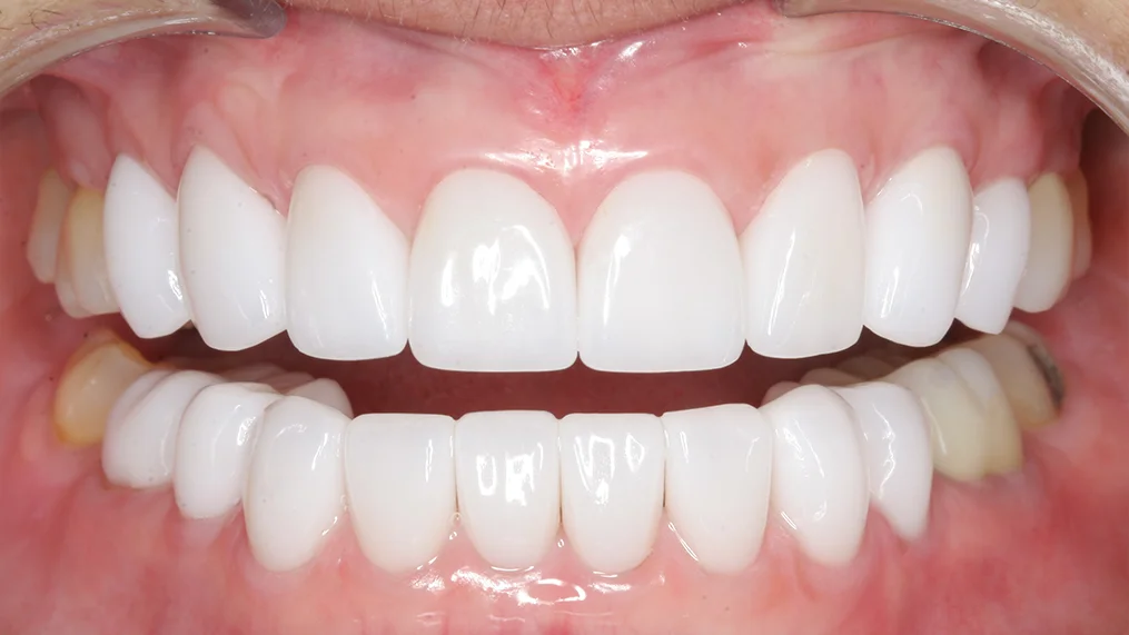 After dental treatment at Metropolitan Dental Centre, case 06