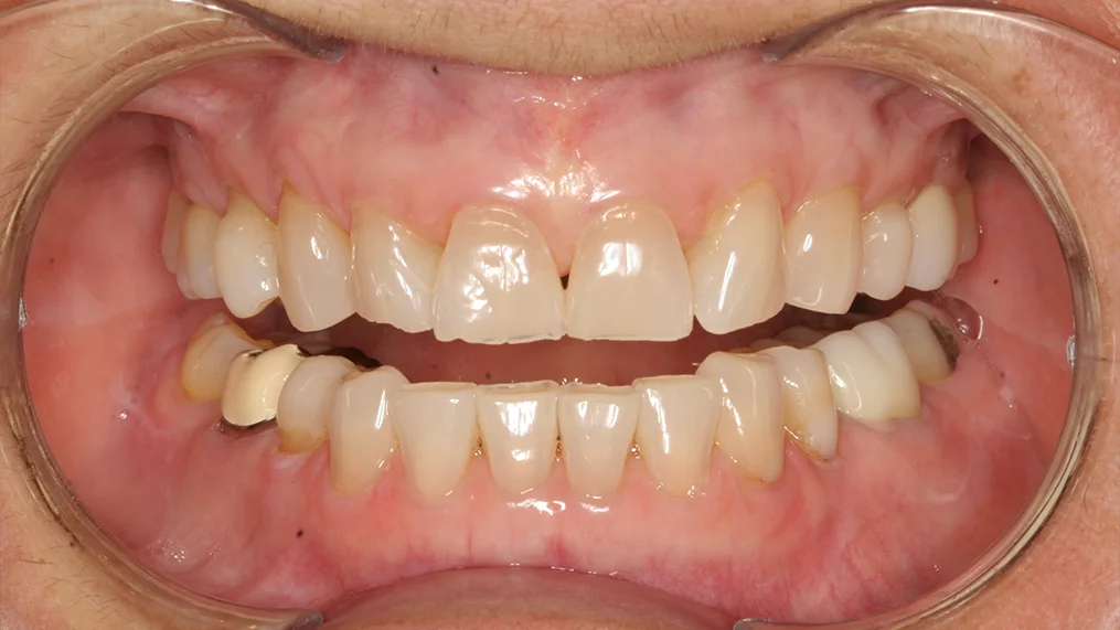 Before dental treatment at Metropolitan Dental Centre, case 06