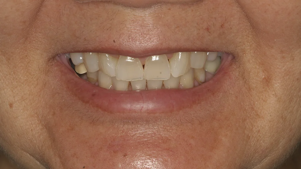 Before — Metropolitan Dental Centre case 06