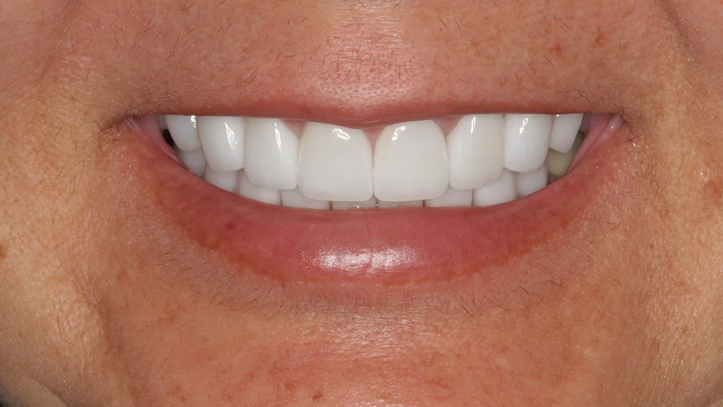 After — Metropolitan Dental Centre case 06