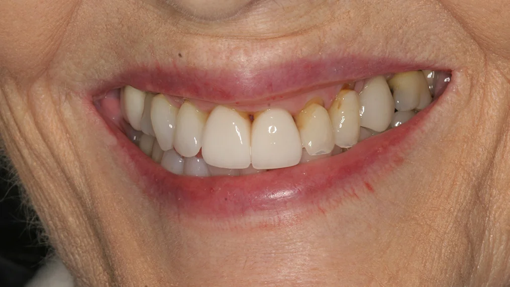 Before — Metropolitan Dental Centre case 07