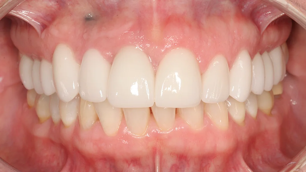 After dental treatment at Metropolitan Dental Centre, case 08