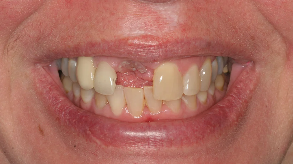 Before — Metropolitan Dental Centre case 08