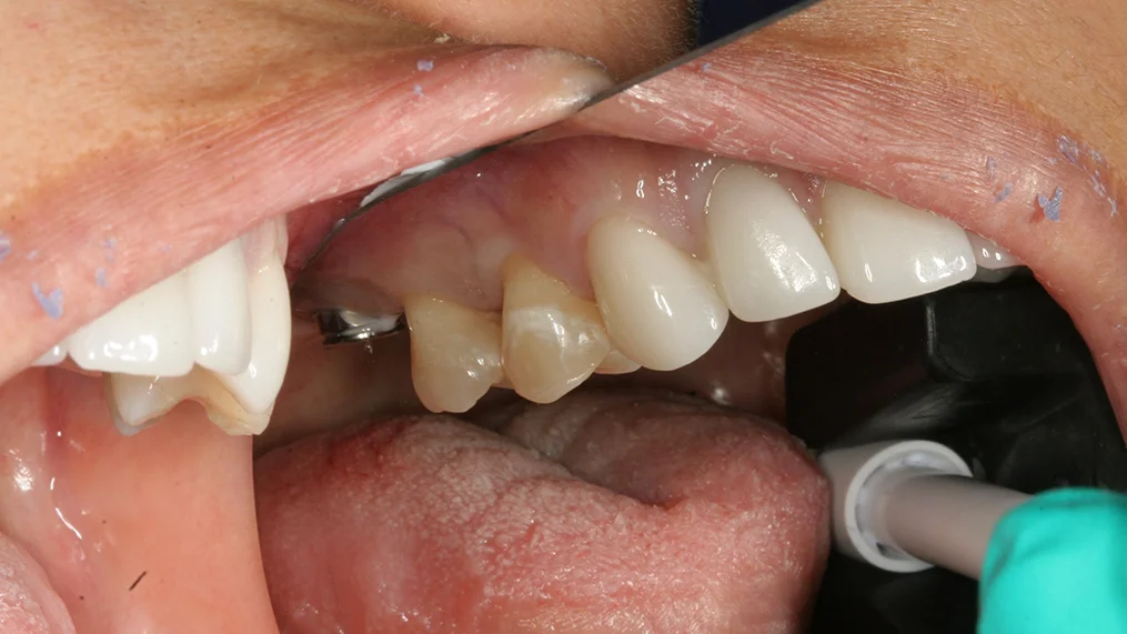 Before dental treatment at Metropolitan Dental Centre, case 09