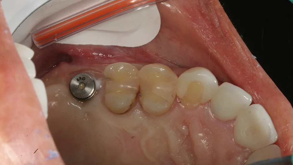 Before — Metropolitan Dental Centre case 09