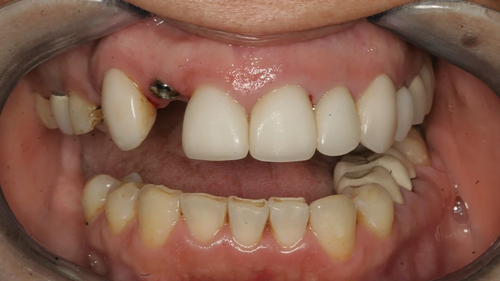 Before dental treatment at Metropolitan Dental Centre, case 10