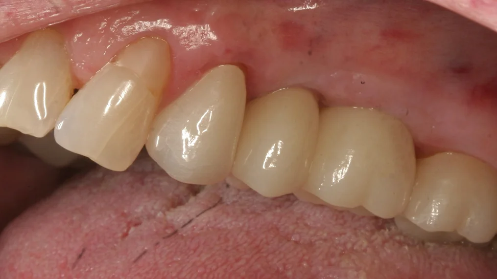After dental treatment at Metropolitan Dental Centre, case 11