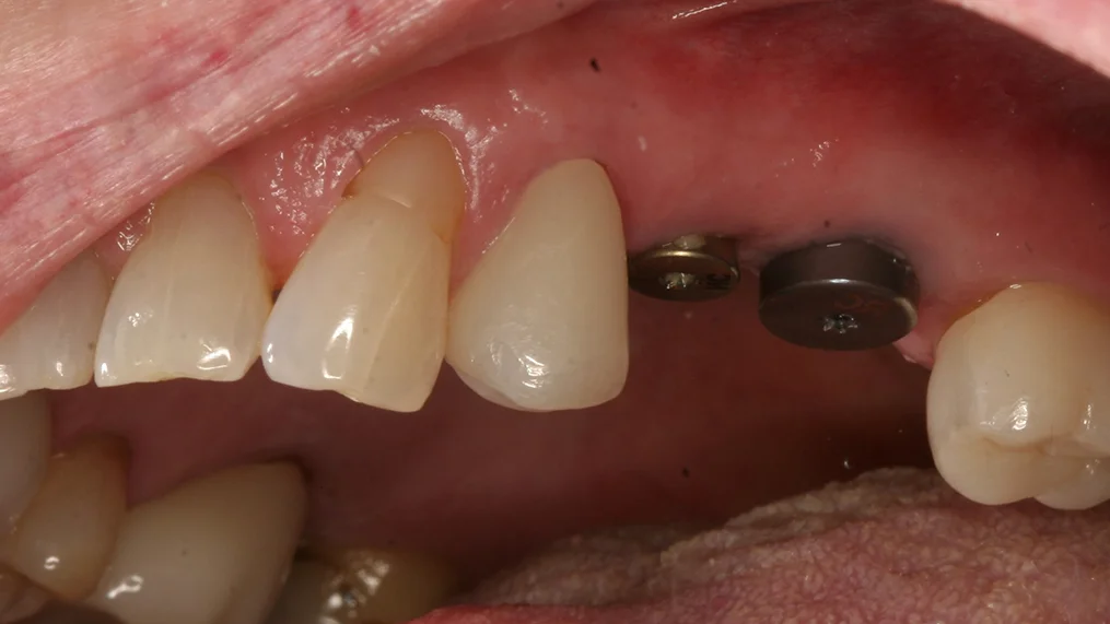 Before dental treatment at Metropolitan Dental Centre, case 11