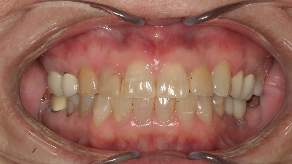 Before dental treatment at Metropolitan Dental Centre, case 12