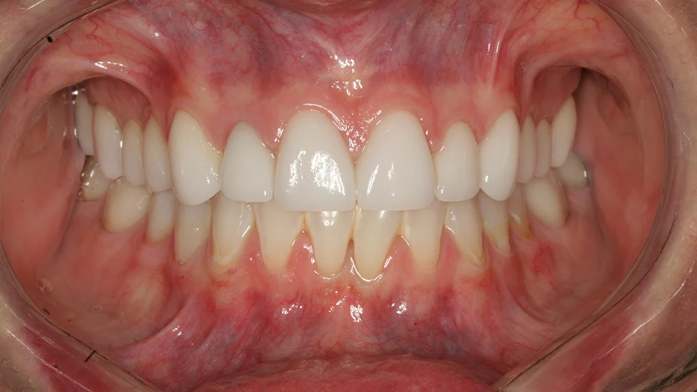 After dental treatment at Metropolitan Dental Centre, case 13