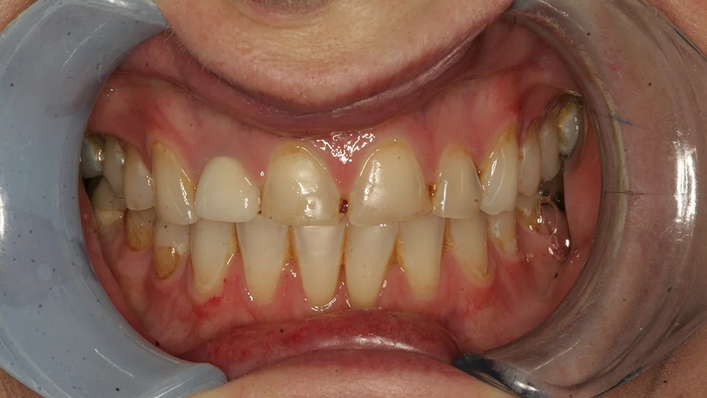 Before dental treatment at Metropolitan Dental Centre, case 13