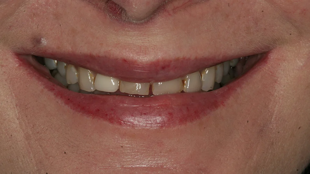 Before — Metropolitan Dental Centre case 13