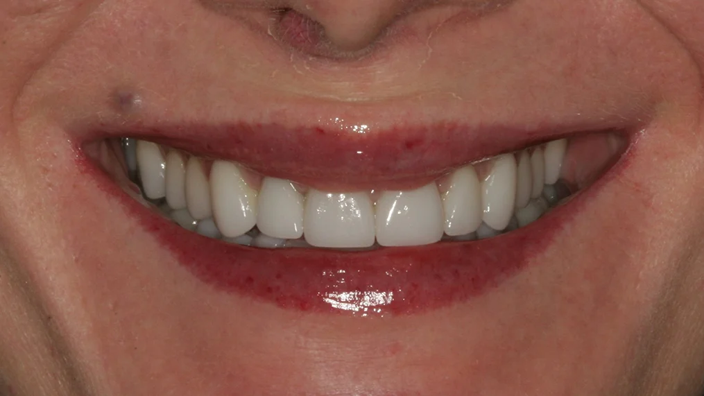 After — Metropolitan Dental Centre case 13