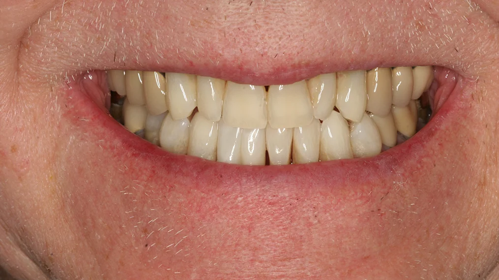 After dental treatment at Metropolitan Dental Centre, case 14