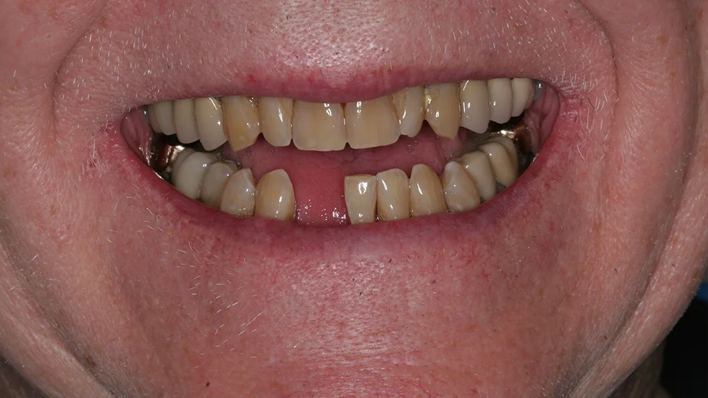 Before dental treatment at Metropolitan Dental Centre, case 14