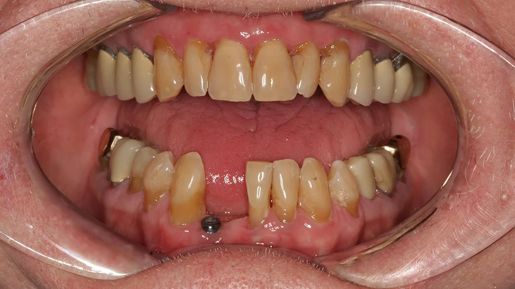 Before — Metropolitan Dental Centre case 14
