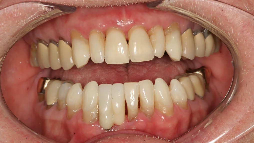 After — Metropolitan Dental Centre case 14