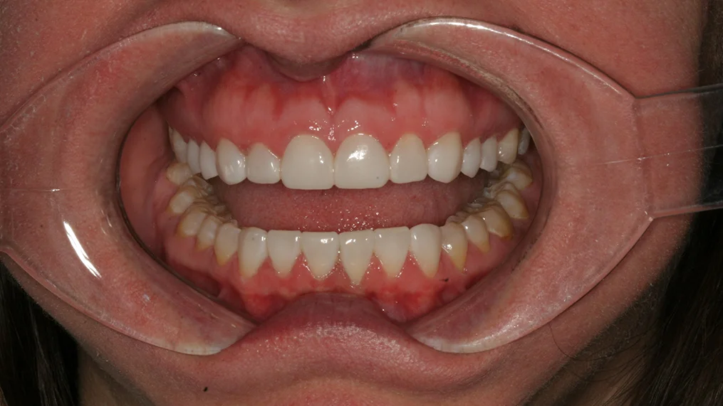 After dental treatment at Metropolitan Dental Centre, case 15