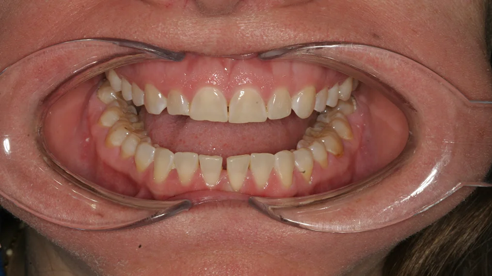Before dental treatment at Metropolitan Dental Centre, case 15