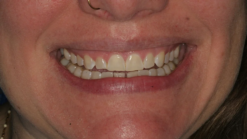 Before — Metropolitan Dental Centre case 15