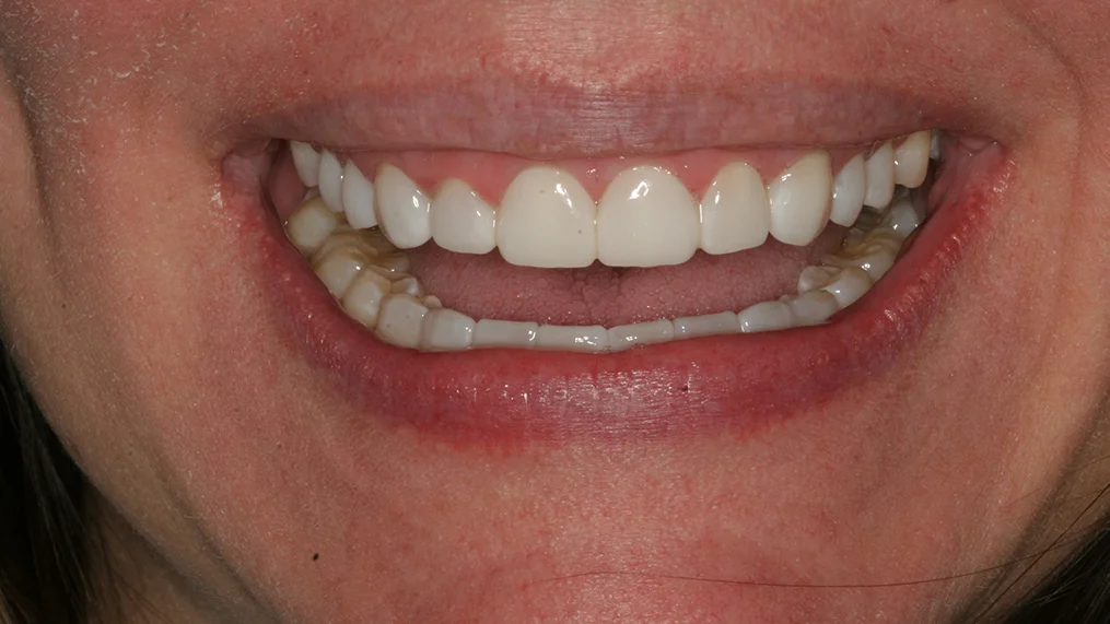 After — Metropolitan Dental Centre case 15