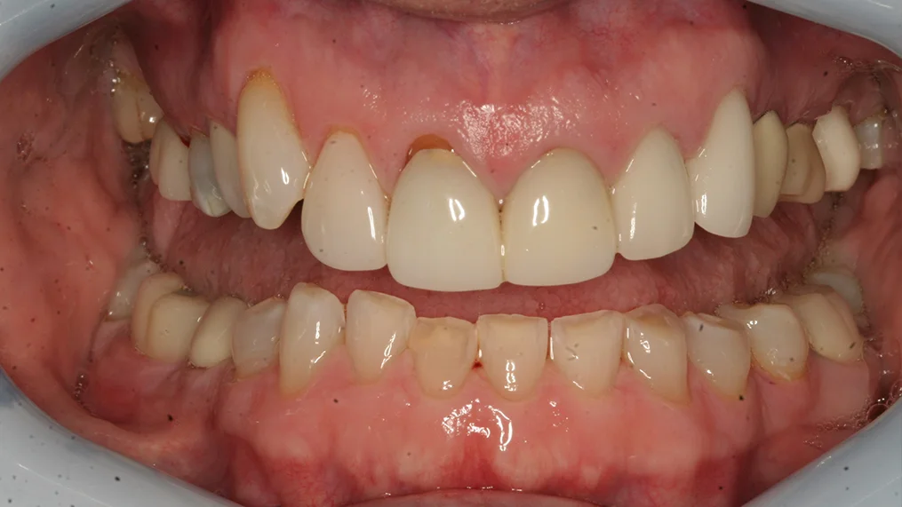Before dental treatment at Metropolitan Dental Centre, case 16