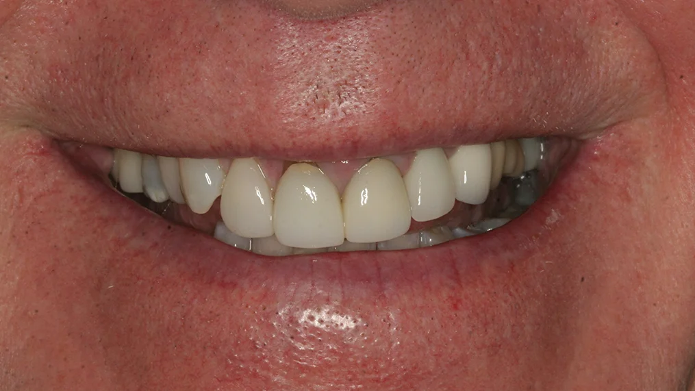 Before — Metropolitan Dental Centre case 16