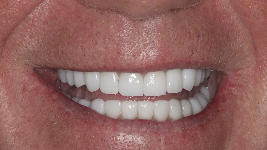 After — Metropolitan Dental Centre case 16