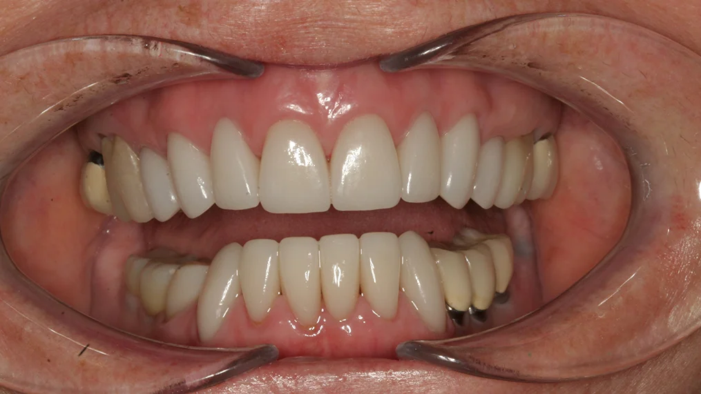 After dental treatment at Metropolitan Dental Centre, case 17