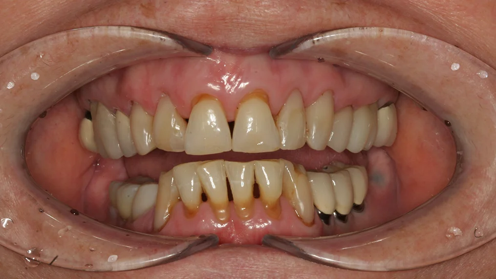 Before dental treatment at Metropolitan Dental Centre, case 17
