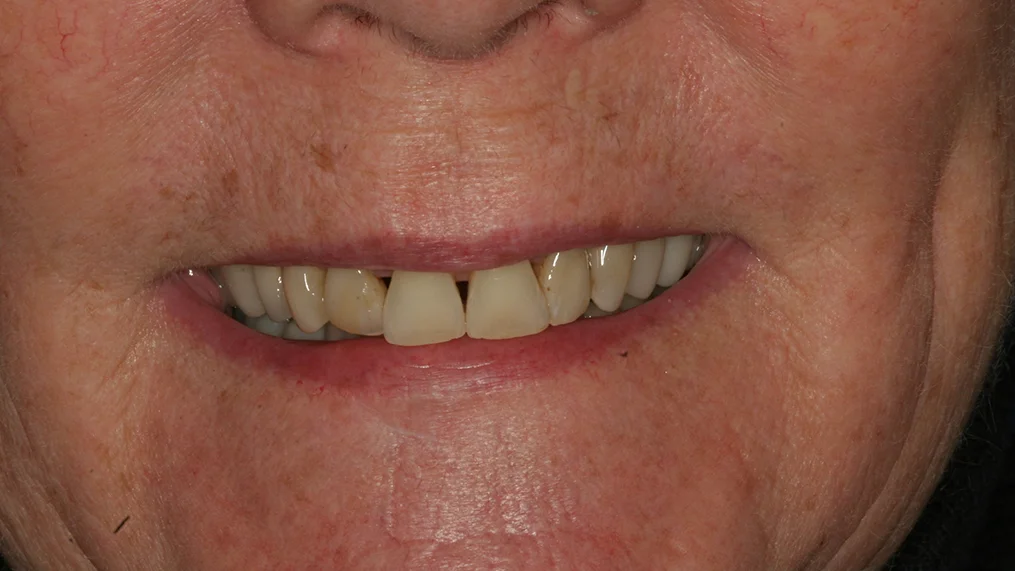 Before — Metropolitan Dental Centre case 17