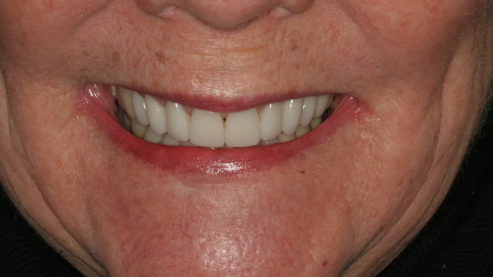 After — Metropolitan Dental Centre case 17