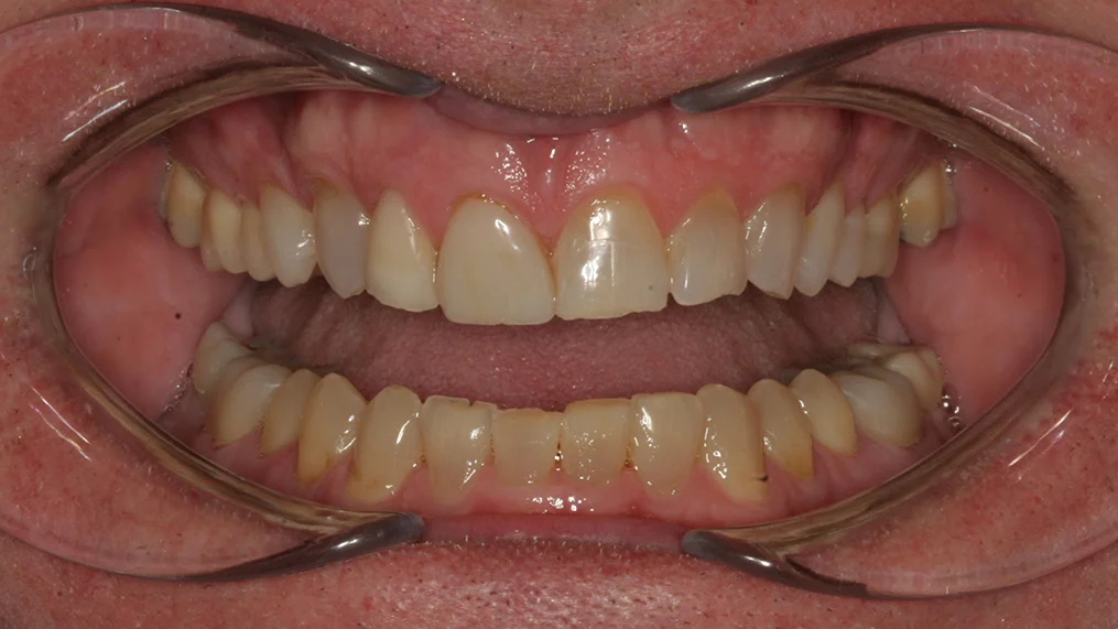 Before dental treatment at Metropolitan Dental Centre, case 18