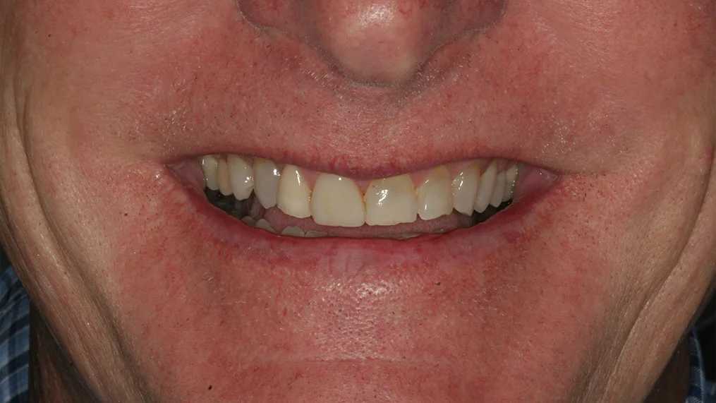 Before — Metropolitan Dental Centre case 18