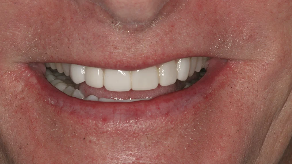 After — Metropolitan Dental Centre case 18